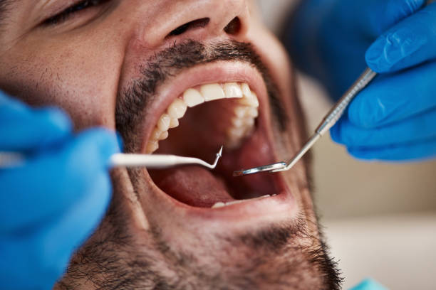 Best Emergency Treatment for Dental Infections or Abscesses in Gramercy, LA